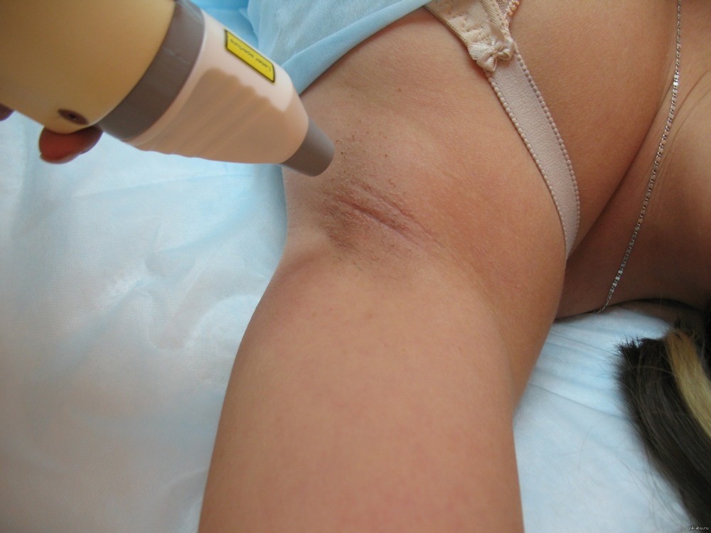 Шугаринг до после генеталии