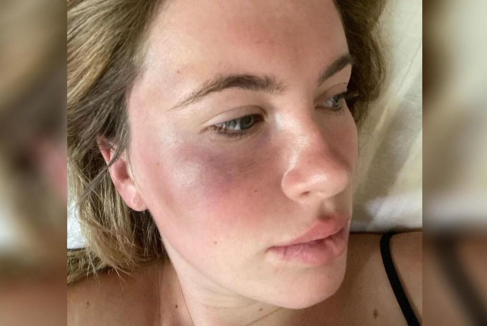 Холли Берри bruised