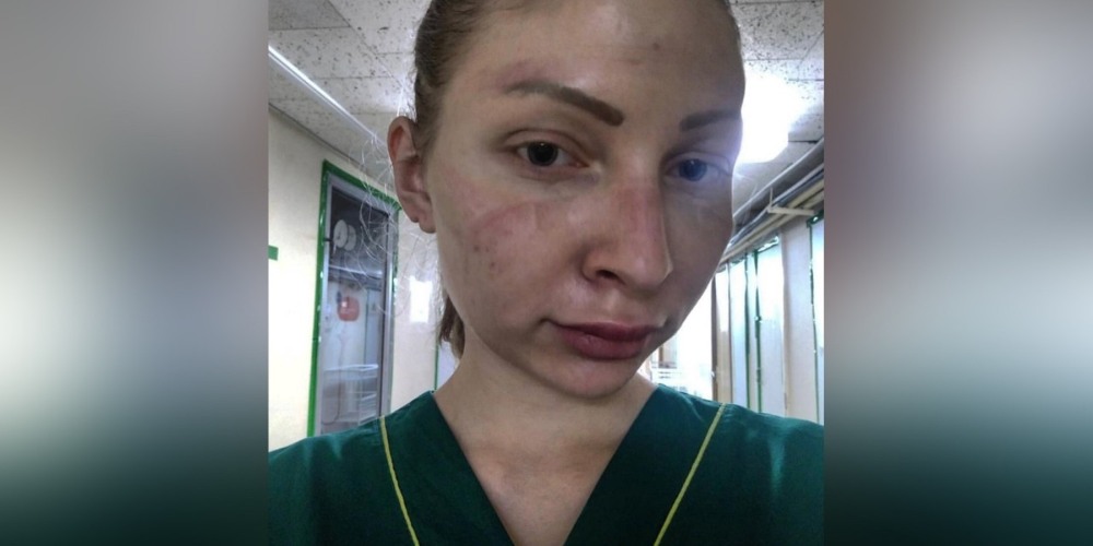 Дина саева ринопластика