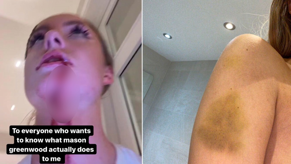 Гель от синяков после операции