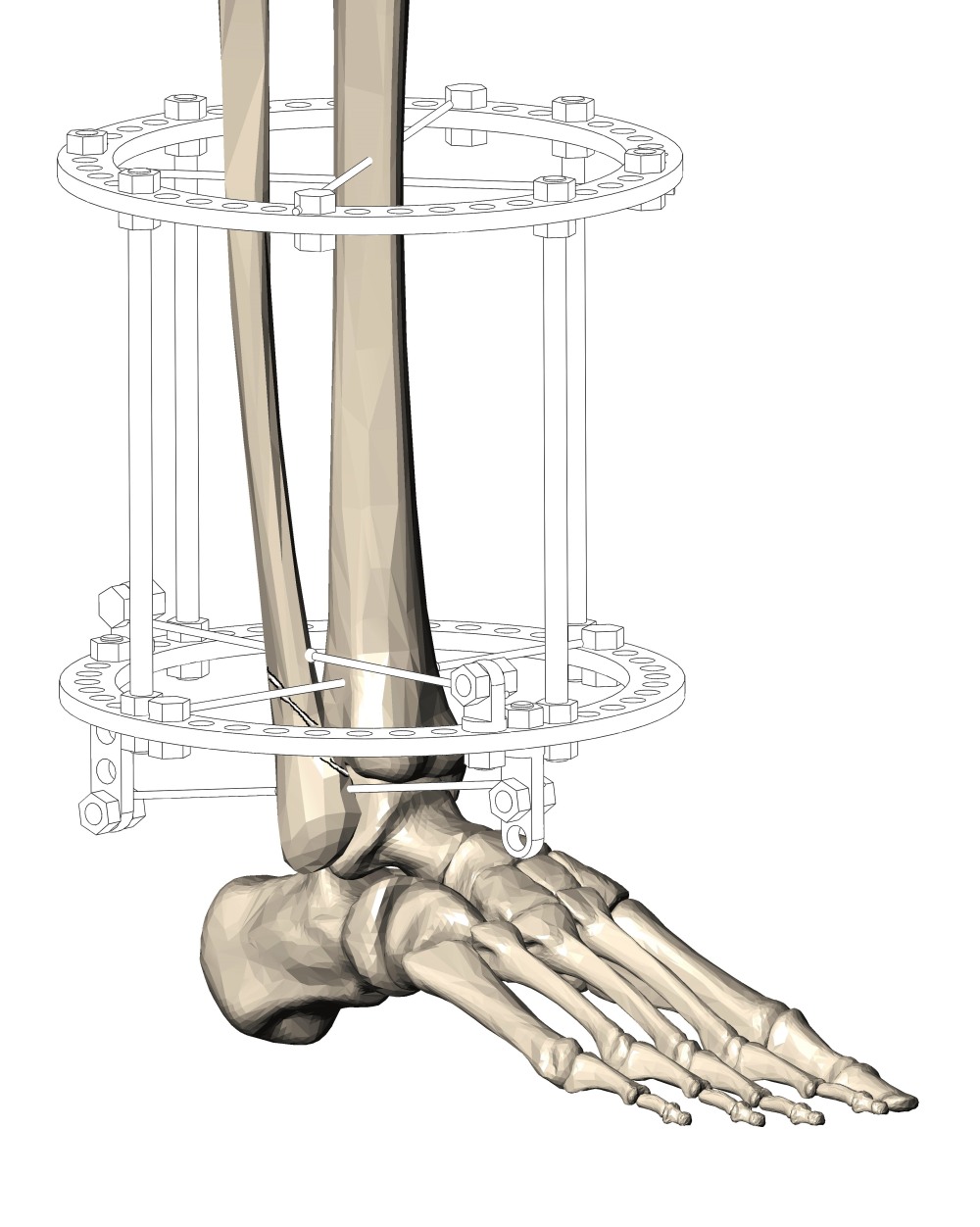 Перелом голеностопа аппарат Илизарова